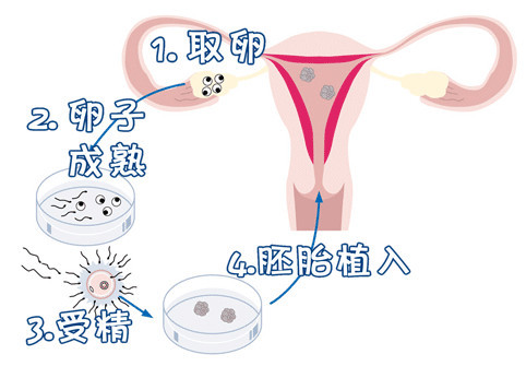 第三代试管婴儿